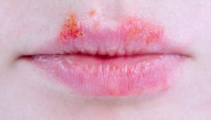 herpes1
